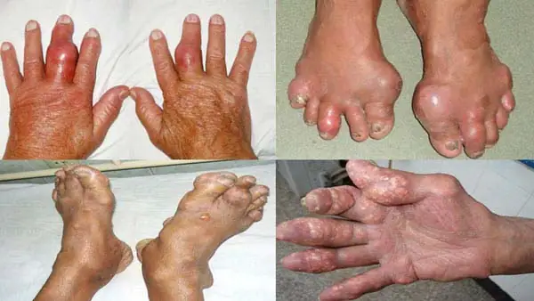 Bệnh Gút Cấp Là Gì? Nguyên Nhân, Triệu Chứng & Cách Xử Trí Hiệu Quả