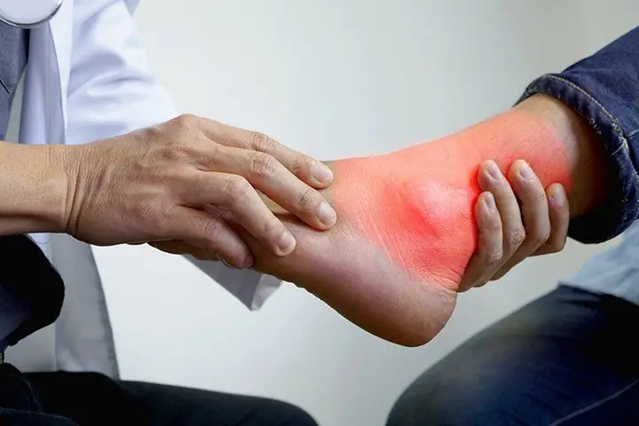 Bệnh Gút Cấp Là Gì? Nguyên Nhân, Triệu Chứng & Cách Xử Trí Hiệu Quả