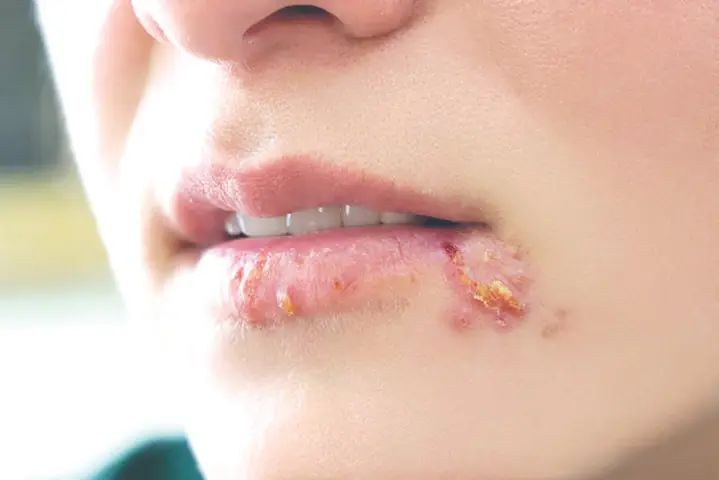 Herpes Là Bệnh Gì? Nguyên Nhân, Triệu Chứng Và Cách Điều Trị Hiệu Quả