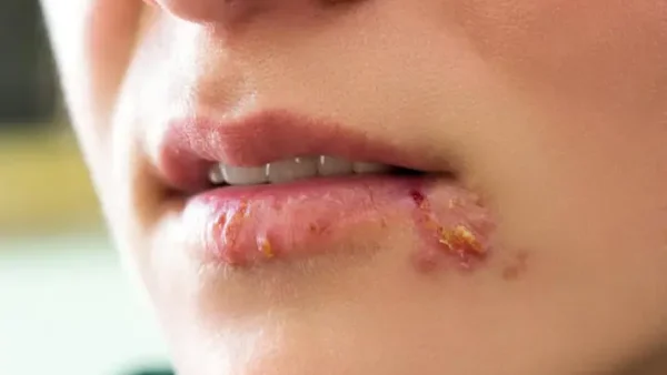 Herpes Là Bệnh Gì? Nguyên Nhân, Triệu Chứng Và Cách Điều Trị Hiệu Quả