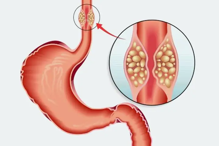 Bệnh K Thực Quản Là Gì? Nguyên Nhân, Dấu Hiệu Và Cách Phòng Ngừa Sớm