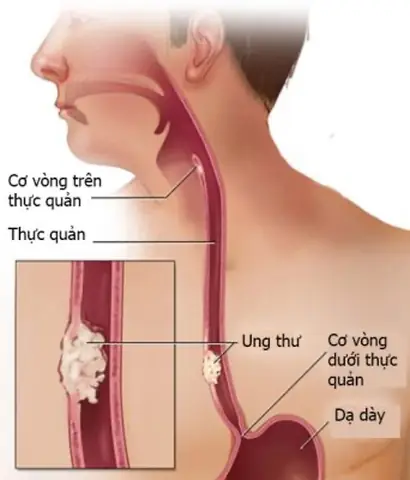 Bệnh K Thực Quản Là Gì? Nguyên Nhân, Dấu Hiệu Và Cách Phòng Ngừa Sớm