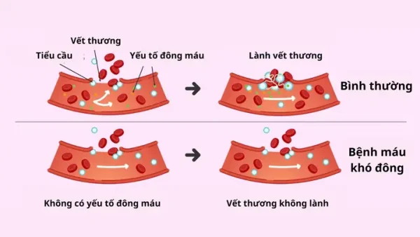 Bệnh Không Đông Máu (hemophilia): Nguyên Nhân, Triệu Chứng, Chẩn Đoán & Điều Trị