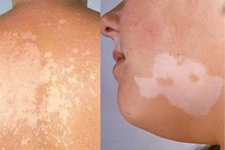 Lang Ben Là Gì? Nguyên Nhân, Triệu Chứng Và Cách Điều Trị Hiệu Quả Lang Ben Là Gì? Nguyên Nhân, Triệu Chứng Và Cách Điều Trị Hiệu Quả