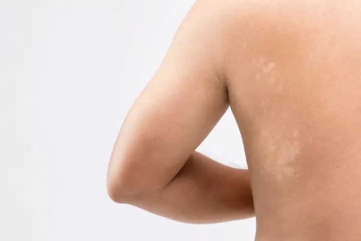 Lang Ben Là Gì? Nguyên Nhân, Triệu Chứng Và Cách Điều Trị Hiệu Quả Lang Ben Là Gì? Nguyên Nhân, Triệu Chứng Và Cách Điều Trị Hiệu Quả