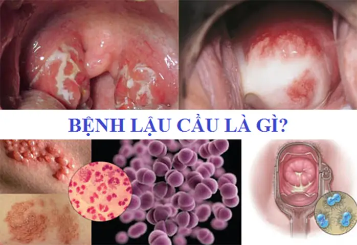 Nhiễm Lậu Cầu Là Gì? Nguyên Nhân, Triệu Chứng Và Cách Điều Trị Hiệu Quả