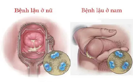 Nhiễm Lậu Cầu Là Gì? Nguyên Nhân, Triệu Chứng Và Cách Điều Trị Hiệu Quả