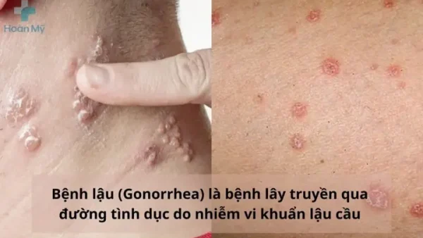 Bệnh Lậu Là Gì? Dấu Hiệu, Biểu Hiện Ban Đầu Và Cách Nhận Biết Sớm