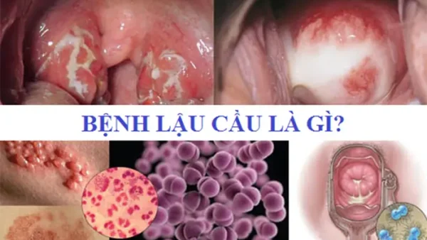 Bệnh Lậu Là Gì, Triệu Chứng Và Cách Điều Trị Dứt Điểm Hiệu Quả
