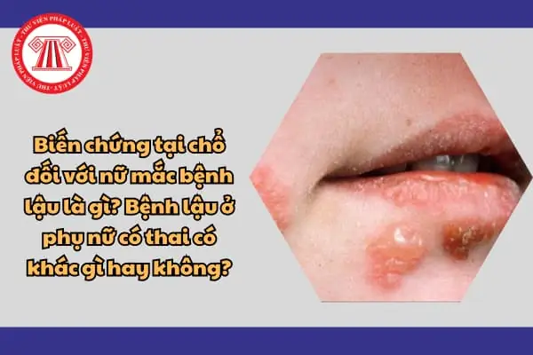 Bệnh Lậu Ở Phụ Nữ: Nguyên Nhân, Triệu Chứng, Nguy Hiểm Và Cách Phòng Ngừa Hiệu Quả