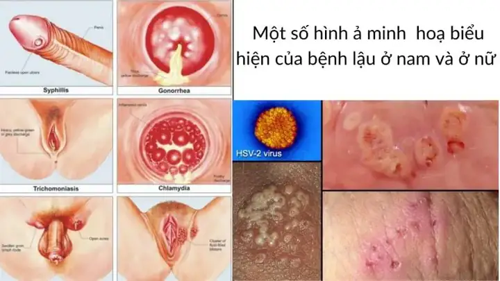 Bệnh Lậu Ở Phụ Nữ: Nguyên Nhân, Triệu Chứng, Nguy Hiểm Và Cách Phòng Ngừa Hiệu Quả