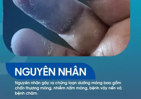 Bệnh Loạn Dưỡng Móng: Nguyên Nhân, Triệu Chứng Và Cách Điều Trị Hiệu Quả