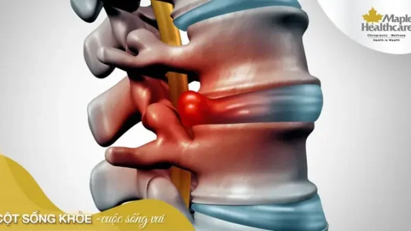 Lồi Đĩa Đệm Là Gì? Nguyên Nhân, Triệu Chứng Và Cách Chữa Trị Hiệu Quả