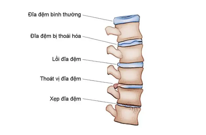 Lồi Đĩa Đệm Là Gì? Nguyên Nhân, Triệu Chứng Và Cách Chữa Trị Hiệu Quả Lồi Đĩa Đệm Là Gì? Nguyên Nhân, Triệu Chứng Và Cách Chữa Trị Hiệu Quả