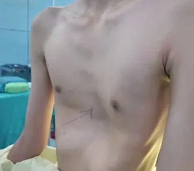 Lõm Ngực Là Gì? Nguyên Nhân, Dấu Hiệu Và Cách Điều Trị Hiệu Quả