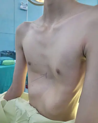 Lõm Ngực Là Gì? Nguyên Nhân, Dấu Hiệu Và Cách Điều Trị Hiệu Quả