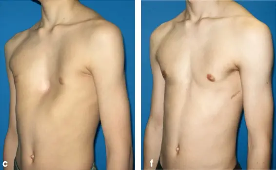 Lõm Ngực Là Gì? Nguyên Nhân, Dấu Hiệu Và Cách Điều Trị Hiệu Quả