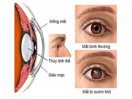 Bệnh Mắt Cườm Nước Là Gì? Nguyên Nhân, Triệu Chứng Và Cách Điều Trị Glaucoma