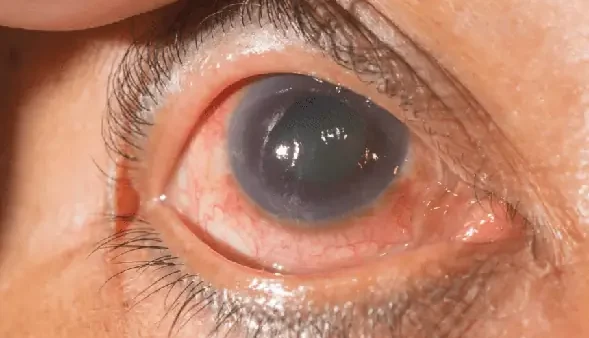 Bệnh Mắt Cườm Nước Là Gì? Nguyên Nhân, Triệu Chứng Và Cách Điều Trị Glaucoma