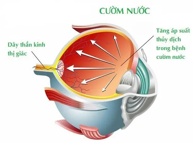 Bệnh Mắt Cườm Nước Là Gì? Nguyên Nhân, Triệu Chứng Và Cách Điều Trị Glaucoma