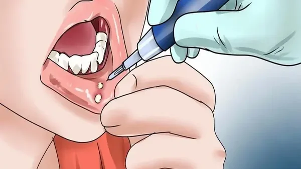Nhiệt Miệng Là Gì? Nguyên Nhân, Dấu Hiệu Nhận Biết Và Cách Điều Trị Hiệu Quả