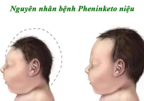 Bệnh Pheninketo Niệu (PKU) Là Gì? Nguyên Nhân, Triệu Chứng Và Cách Điều Trị