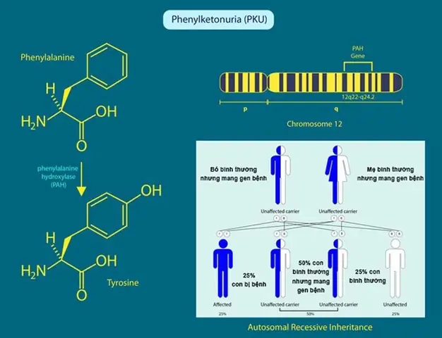 Bệnh Pheninketo Niệu (PKU) Là Gì? Nguyên Nhân, Triệu Chứng Và Cách Điều Trị