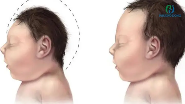 Bệnh Pheninketo Niệu (PKU) Là Gì? Nguyên Nhân, Triệu Chứng Và Cách Điều Trị