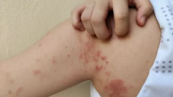 Bệnh Phong Là Gì? Nguyên Nhân, Triệu Chứng, Cách Chữa Trị & Phòng Ngừa
