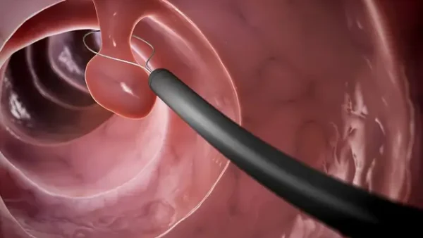 Polyp Dạ Dày Là Gì? Nguyên Nhân, Triệu Chứng Và Cách Xử Trí Hiệu Quả