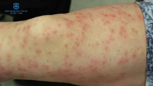 Rubella (sởi Đức): Nguyên Nhân, Triệu Chứng, Cách Phòng Ngừa Và Phân Biệt Với Sởi Thường