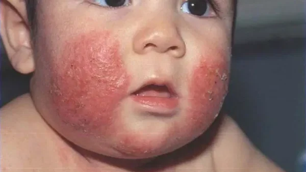 Suy Giảm Miễn Dịch Bẩm Sinh Là Gì? Nguyên Nhân, Dấu Hiệu Và Cách Chẩn Đoán