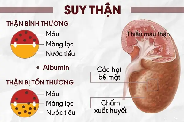 Suy Thận Mạn Là Gì? Nguyên Nhân, Triệu Chứng Và Cách Điều Trị Toàn Diện