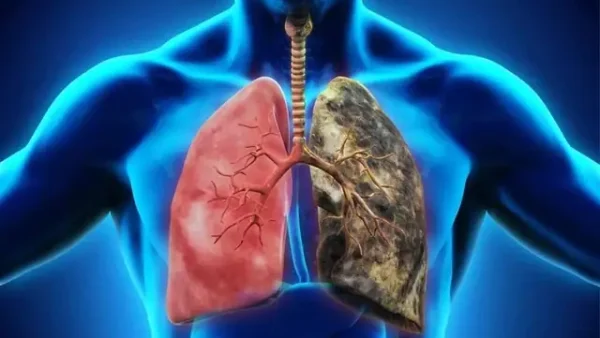 Tâm Phế Mạn Là Gì? Nguyên Nhân, Triệu Chứng Và Cách Điều Trị Hiệu Quả