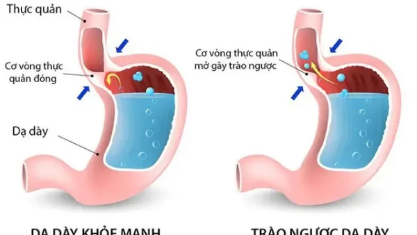 Trào Ngược Dạ Dày Thực Quản Là Gì? Nguyên Nhân, Triệu Chứng & Cách Điều Trị