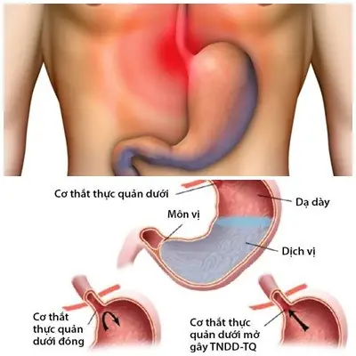 Trào Ngược Dạ Dày Thực Quản Là Gì? Nguyên Nhân, Triệu Chứng & Cách Điều Trị Trào Ngược Dạ Dày Thực Quản Là Gì? Nguyên Nhân, Triệu Chứng & Cách Điều Trị