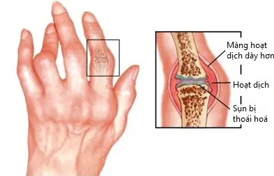 Bệnh Tự Miễn Là Gì? Nguyên Nhân, Triệu Chứng Và Cách Nhận Biết Sớm