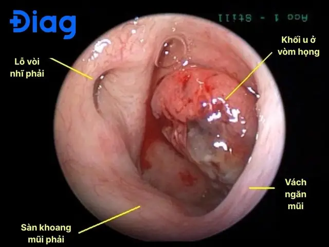 Ung Thư Vòm Họng Là Gì? Nguyên Nhân, Triệu Chứng, Chẩn Đoán & Cách Phòng Ngừa Hiệu Quả