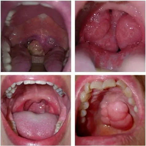 Ung Thư Vòm Họng Là Gì? Nguyên Nhân, Triệu Chứng, Chẩn Đoán & Cách Phòng Ngừa Hiệu Quả