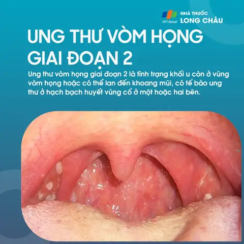 Ung Thư Vòm Họng Là Gì? Nguyên Nhân, Triệu Chứng, Chẩn Đoán & Cách Phòng Ngừa Hiệu Quả