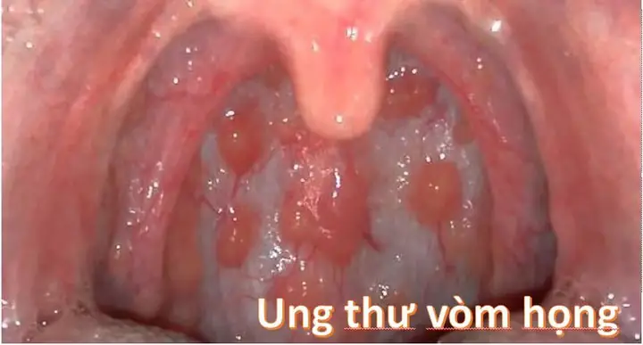 Ung Thư Vòm Họng Là Gì? Nguyên Nhân, Triệu Chứng, Chẩn Đoán & Cách Phòng Ngừa Hiệu Quả