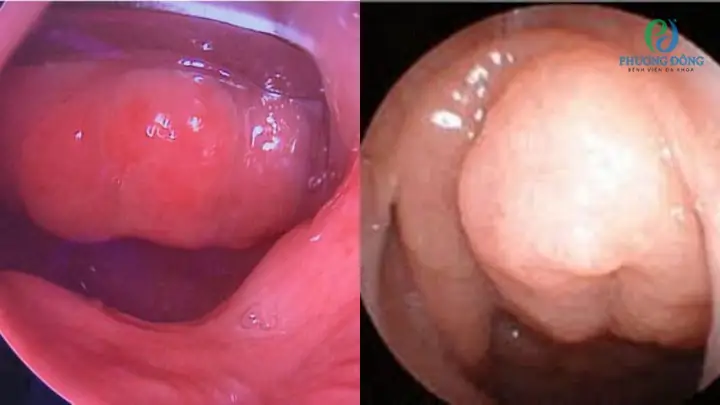 Viêm VA Tồn Dư Là Gì? Nguyên Nhân, Dấu Hiệu Và Cách Xử Trí Hiệu Quả