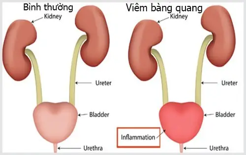 Viêm Bàng Quang Là Gì? Nguyên Nhân, Triệu Chứng, Cách Điều Trị Và Phòng Ngừa
