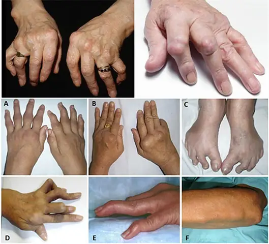 Bệnh Viêm Đa Khớp Là Gì? Nguyên Nhân, Triệu Chứng Và Cách Điều Trị Hiệu Quả