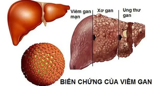 Viêm Gan Mãn Tính Là Gì? Nguyên Nhân, Triệu Chứng Và Cách Đối Phó Toàn Diện