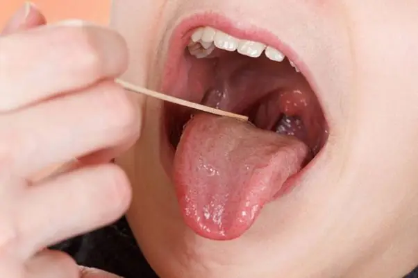 Viêm Họng Cấp Là Gì? Nguyên Nhân, Triệu Chứng Và Cách Điều Trị Hiệu Quả