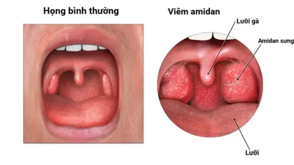 Viêm Họng Cấp Là Gì? Nguyên Nhân, Triệu Chứng Và Cách Điều Trị Hiệu Quả