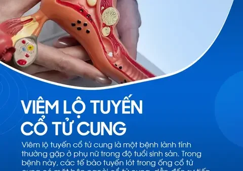 Viêm Lộ Tuyến Cổ Tử Cung Là Gì? Nguyên Nhân, Dấu Hiệu Và Cách Điều Trị Hiệu Quả