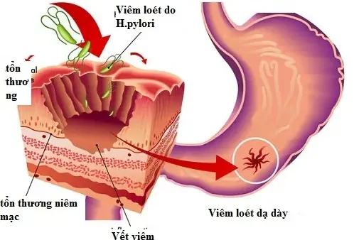 Viêm Loét Dạ Dày Tá Tràng: Nguyên Nhân, Triệu Chứng, Chẩn Đoán Và Cách Phòng Ngừa