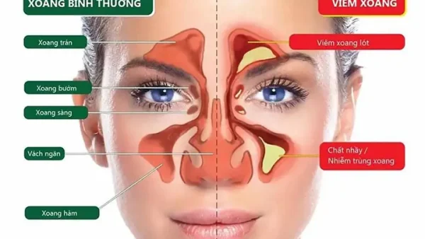 Viêm Xoang Mũi Là Gì? Nguyên Nhân, Triệu Chứng Và Cách Điều Trị Hiệu Quả